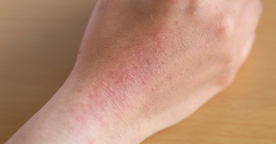 Eczema on hand
