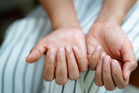 close-up of a woman's brittle and damaged nails