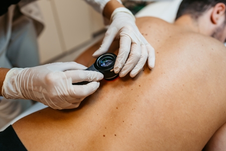 dermatologist examining moles on a man's back