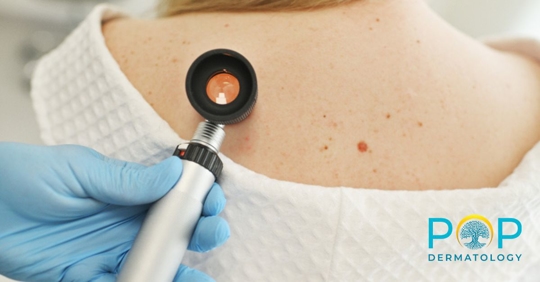 skin cancer screening