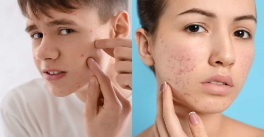 Teen vs adult acne