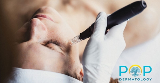 microneedling