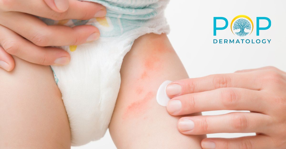 Severe Diaper Rashes: Causes, Prevention, and Professional Treatments ...